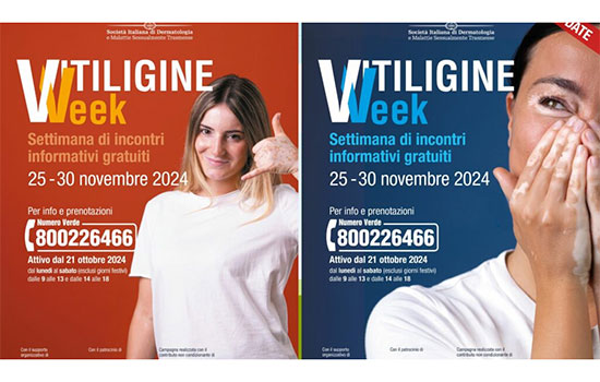 vitiliggine week - calabria